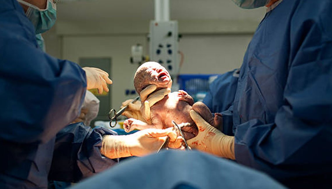 Cesarean Delivery